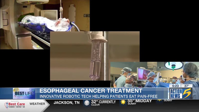 Best life: Esophageal cancer treatment